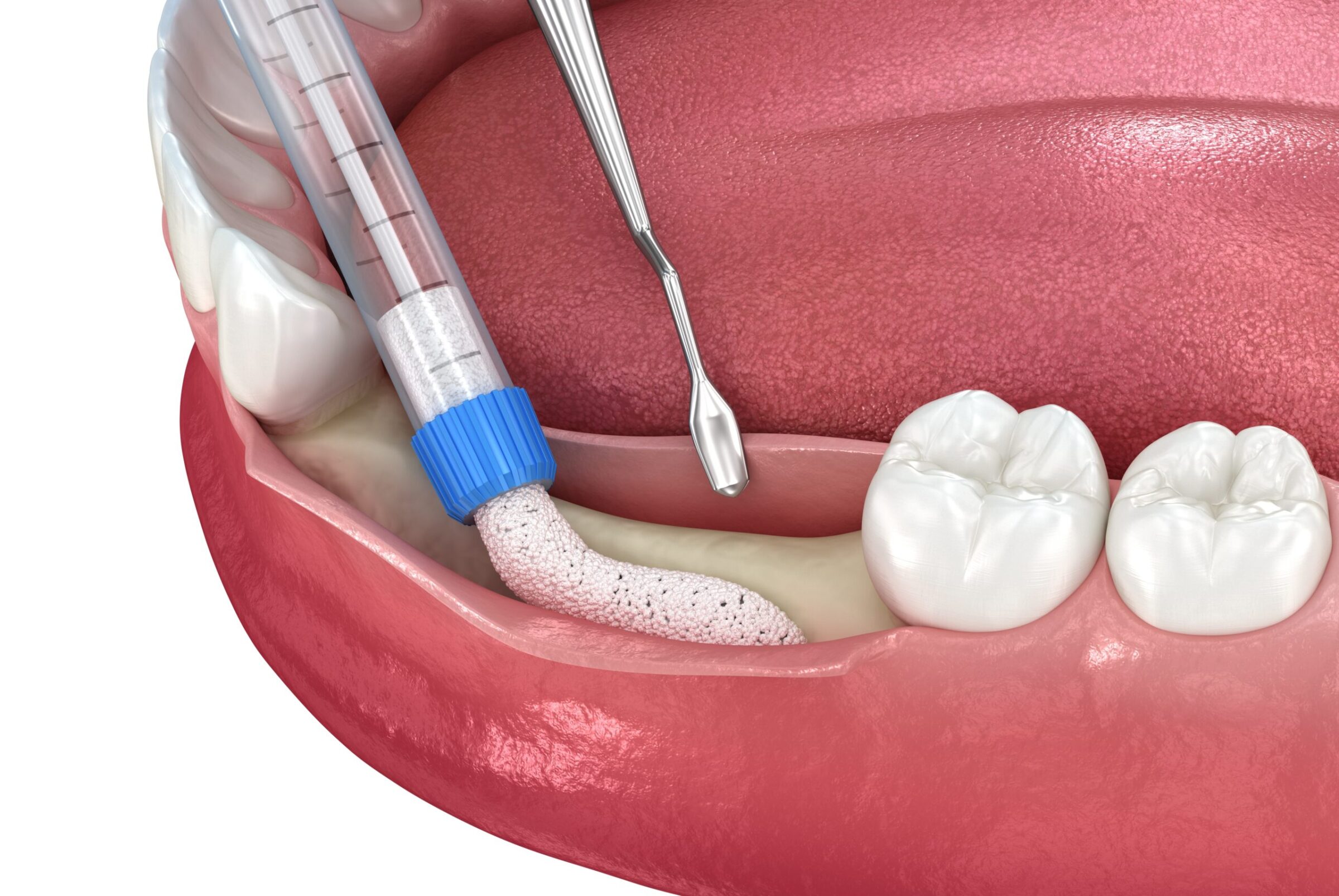 Bone,Grafting,Augmentation,For,Tooth,Implantation.,Medically,Accurate,3d,Illustration.