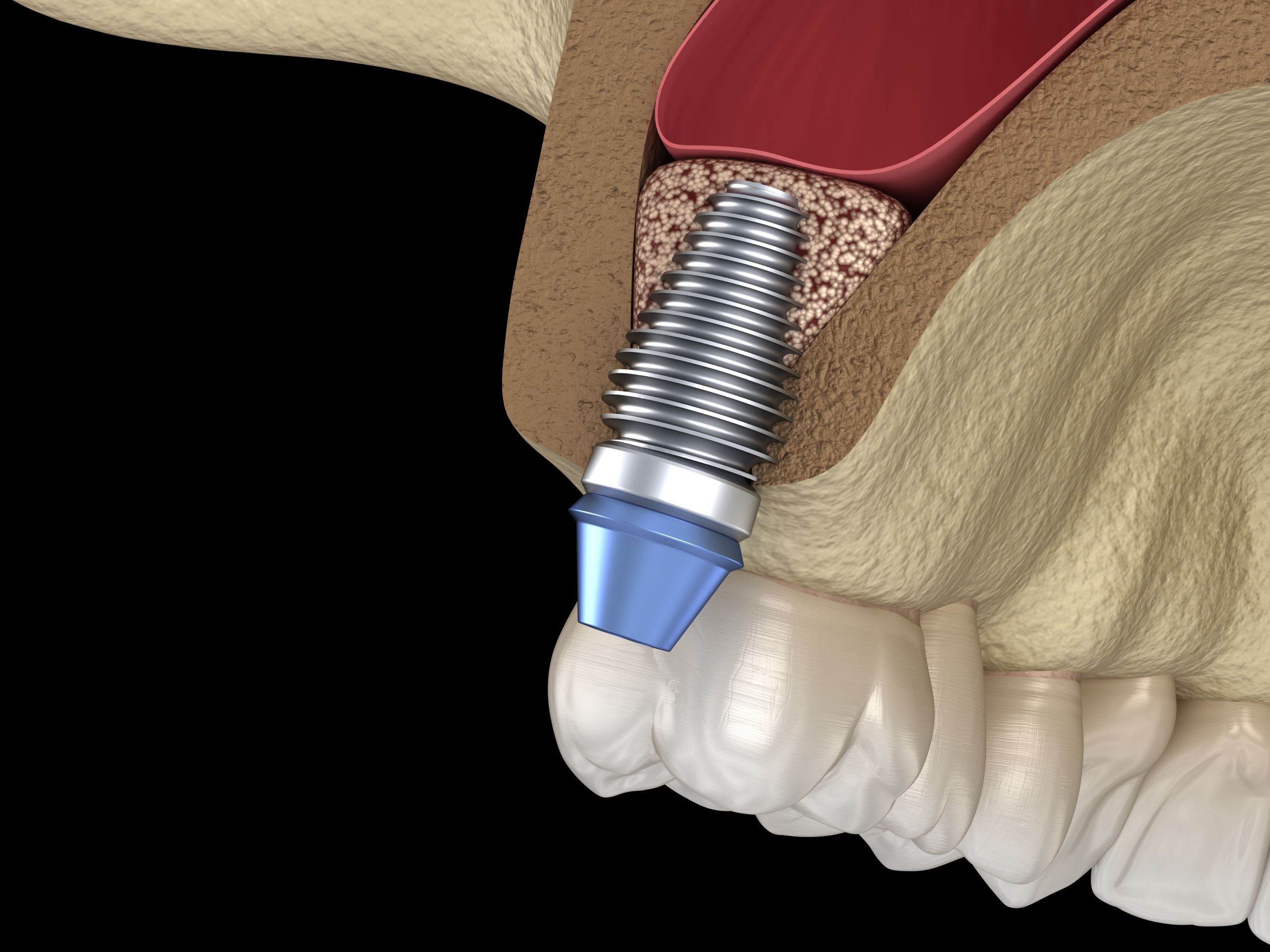 Bitmap in OSSPORE DENTAL LEAFLET COLOR 3 2