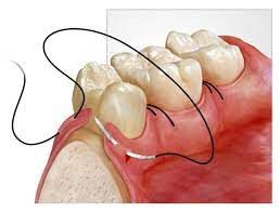 DENTAL SUTURES e1691495688894