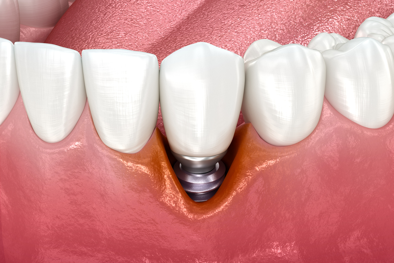 failing implant 1