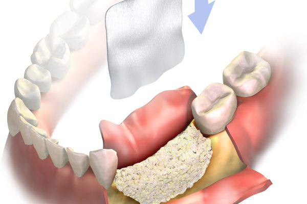 Dental,Membrane,Flying,In,Air,Follow,By,Arrow,Down,,To